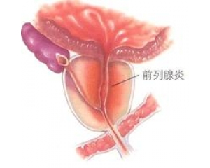 什么是滴虫性前列腺炎？